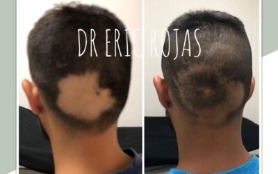 Podemos solucionar la caida de cabello, escríbenos.