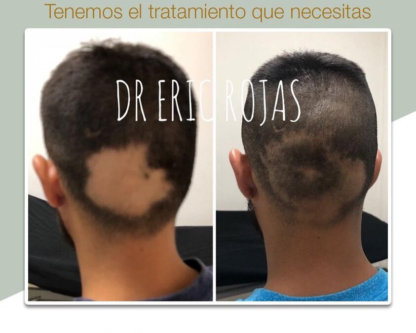 Podemos solucionar la caida de cabello, escríbenos.