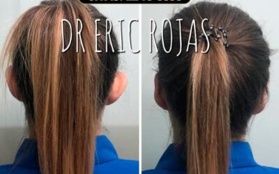 Corrección de orejas con Dermo Otoplastía.