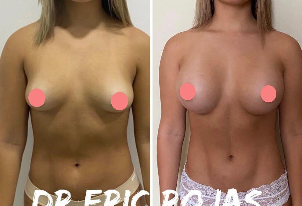 Implantes mamarios, promociones disponibles, luce genial.