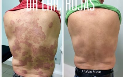 PSORIASIS SE PUEDE CONTROLAR DR ERIC ROJAS 22483535