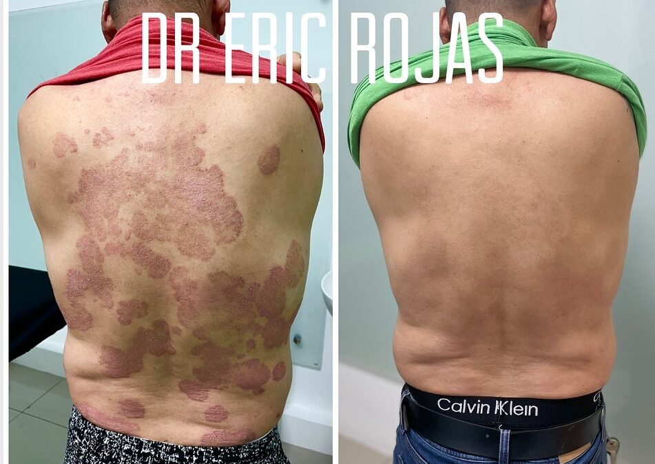 PSORIASIS SE PUEDE CONTROLAR DR ERIC ROJAS 22483535