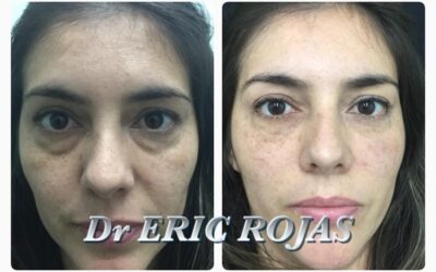 Elimina las ojeras, escríbenos.