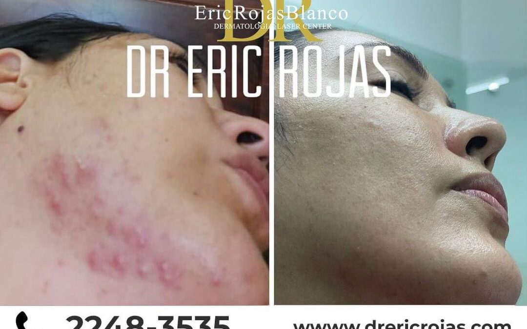 Limpia tu rostro del acné de manera definitiva