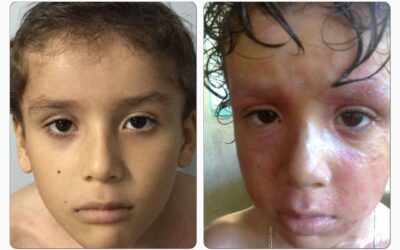 Los problemas de piel de los pequeños del hogar también los tratamos, no dudes en visitarnos.