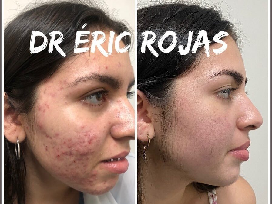 Limpia tu rostro con el mejor tratamiento.