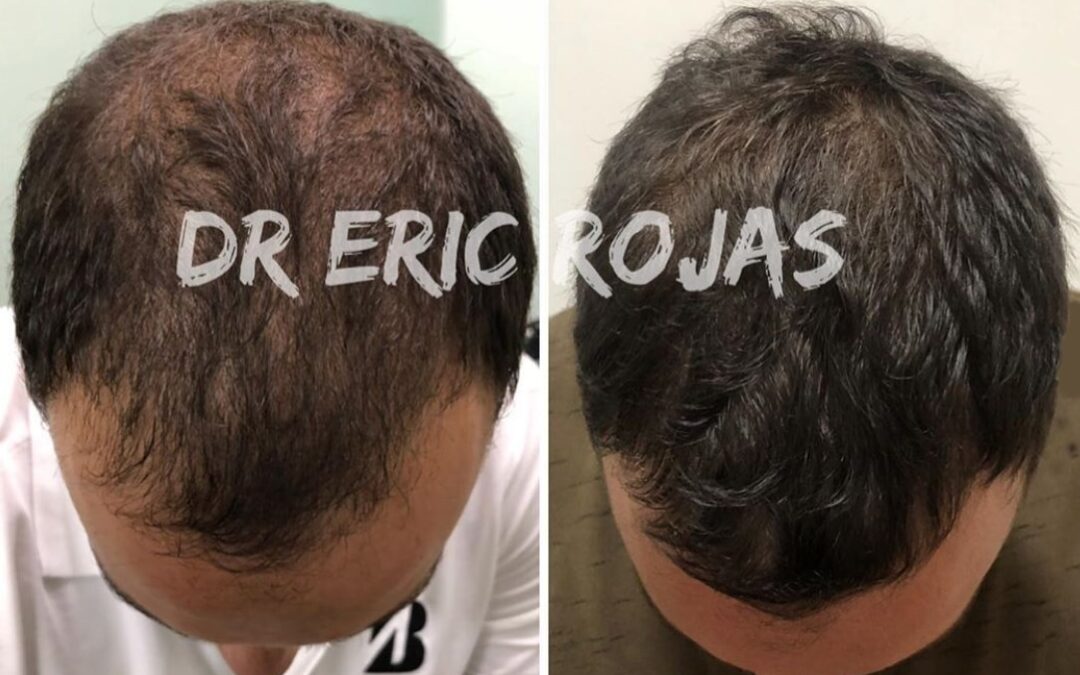 Recupera tu cabello, tratamiento garantizado contra la alopecia.