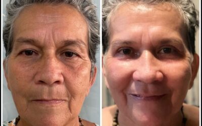 Refrescamiento FACIAL DR ERIC ROJAS 22483535