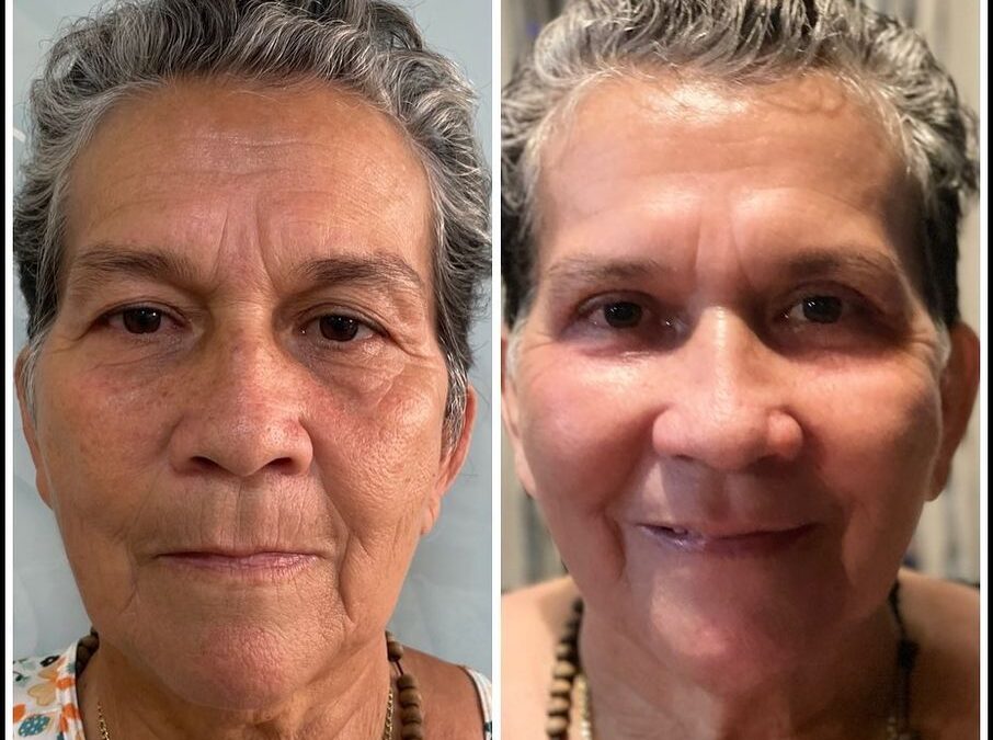 Refrescamiento FACIAL DR ERIC ROJAS 22483535
