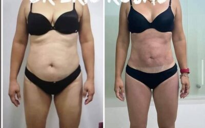 Obtén el cuerpo que deseas con Slim láser.
