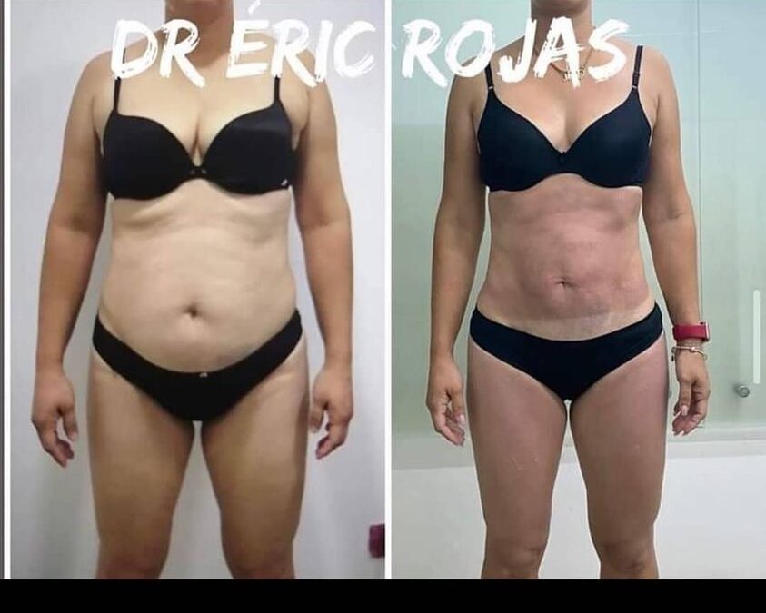 Obtén el cuerpo que deseas con Slim láser.