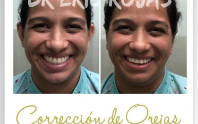 Dermo Otoplastía en promoción.