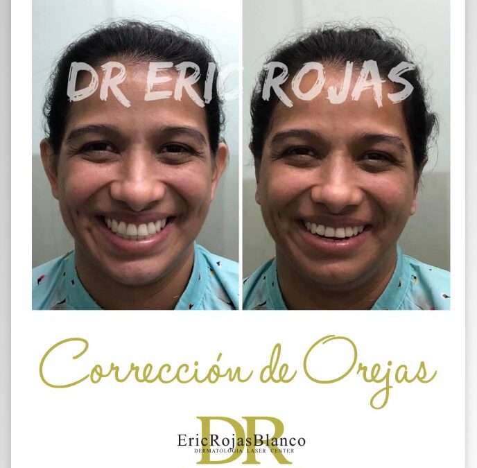 Dermo Otoplastía en promoción.