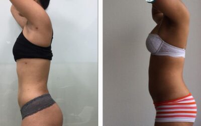 Cambio gracias a Slim Láser, ¿Qué esperas para realizar tu cotización?