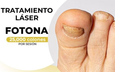 Tratamiento láser para los hongos de tus uñas.