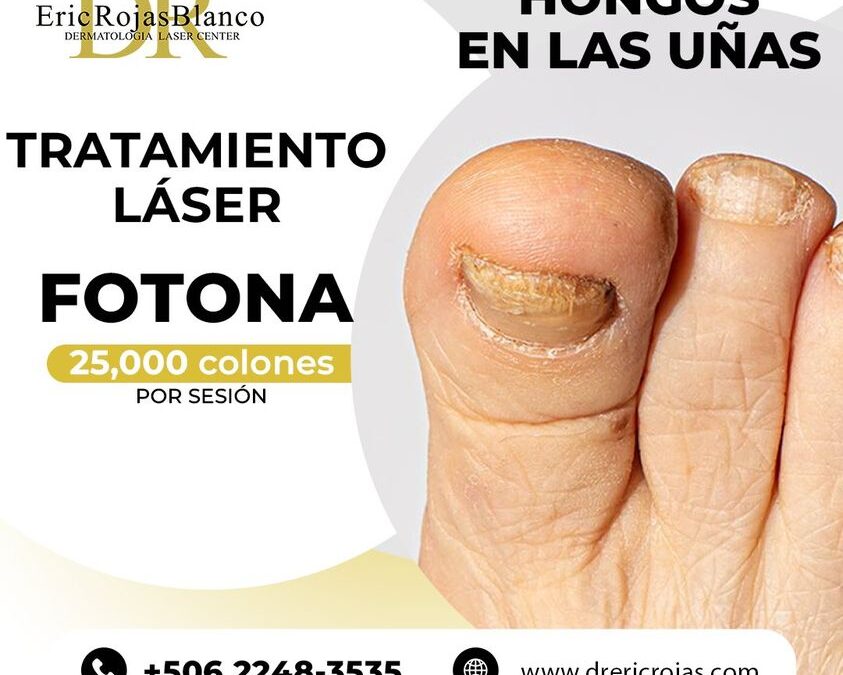 Tratamiento láser para los hongos de tus uñas.