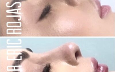 NARIZ PERFECTA EN 5 minutos DR ERIC ROJAS 22483535