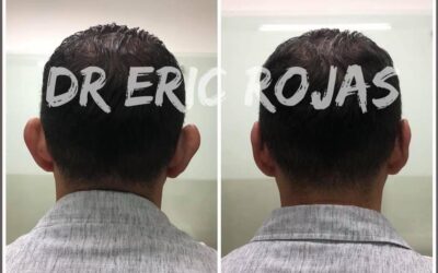 Dermo otoplastía, la mejor oferta $950 dólares.