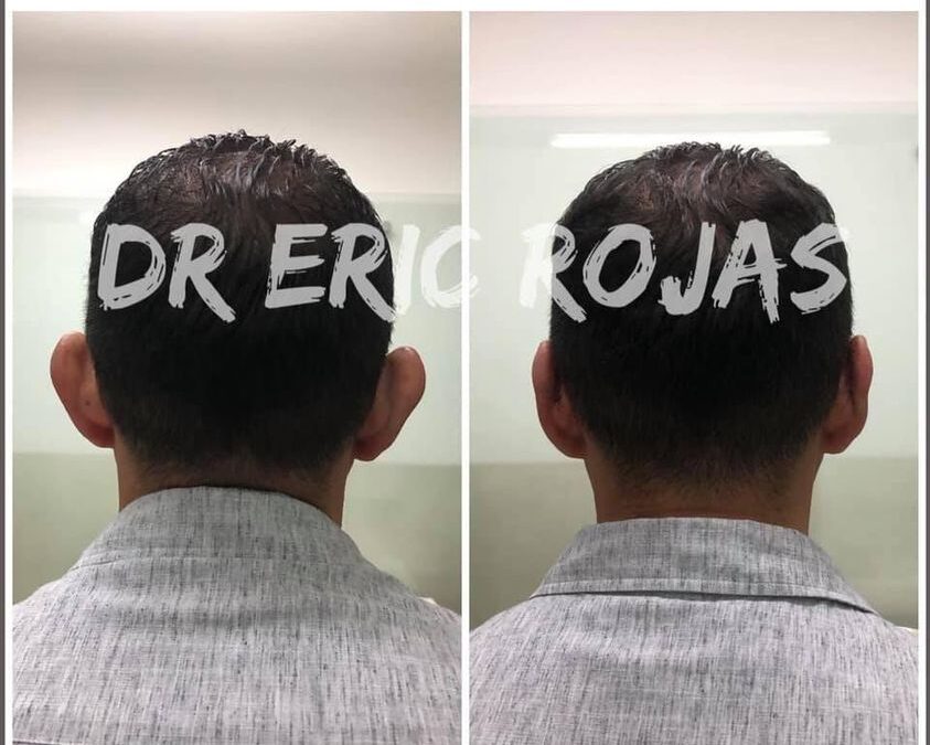 Dermo otoplastía, la mejor oferta $950 dólares.