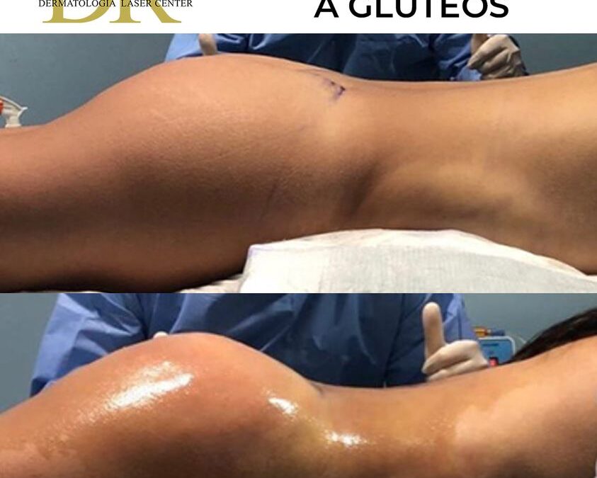 Transferencia a glúteos, increíble resultado.