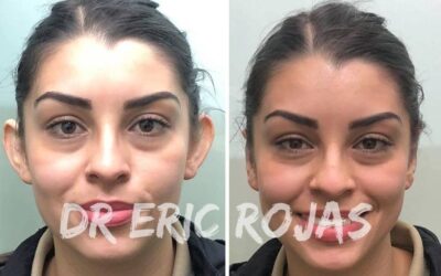 Dermo Otoplastía, con la mejor técnica para mejorar tus orejas.