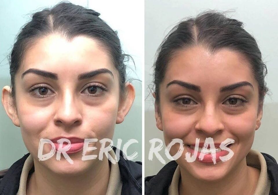 Dermo Otoplastía, con la mejor técnica para mejorar tus orejas.
