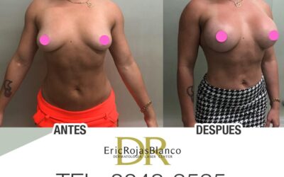 Aumento de mamas desde $2,700 dólares en adelante.
