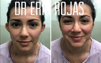 Dermo-Otoplastía, en precio en promoción: $950 dólares