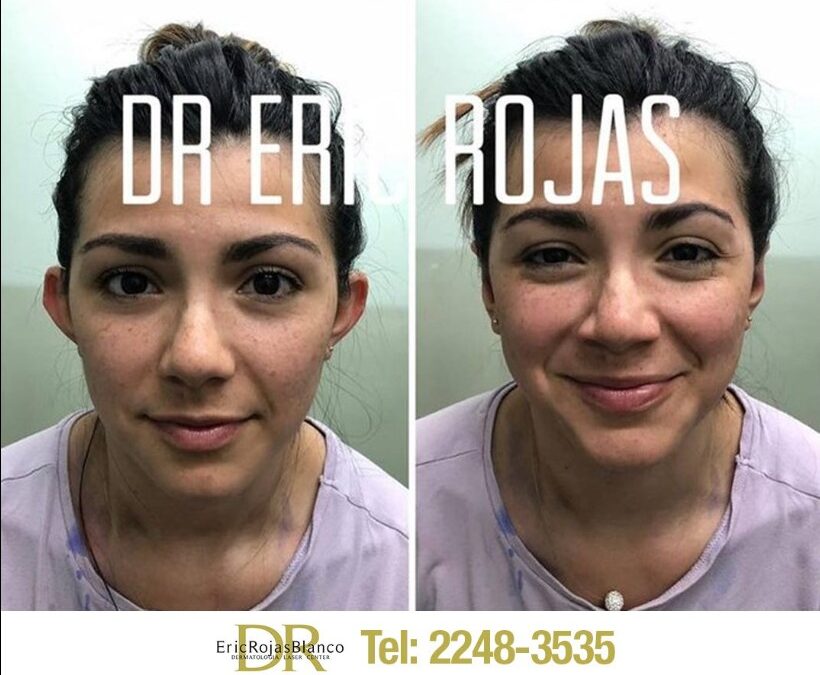 Dermo-Otoplastía, en precio en promoción: $950 dólares