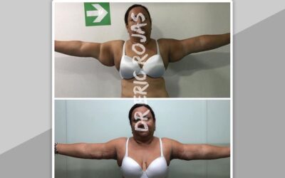 Slim Láser Brazos, la mejor opción para obtener tu cambio.