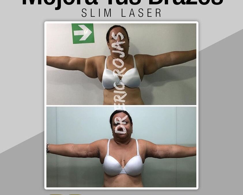 Slim Láser Brazos, la mejor opción para obtener tu cambio.