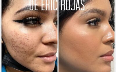 ACNE YA NO MÁS DR ERIC ROJAS 22483535