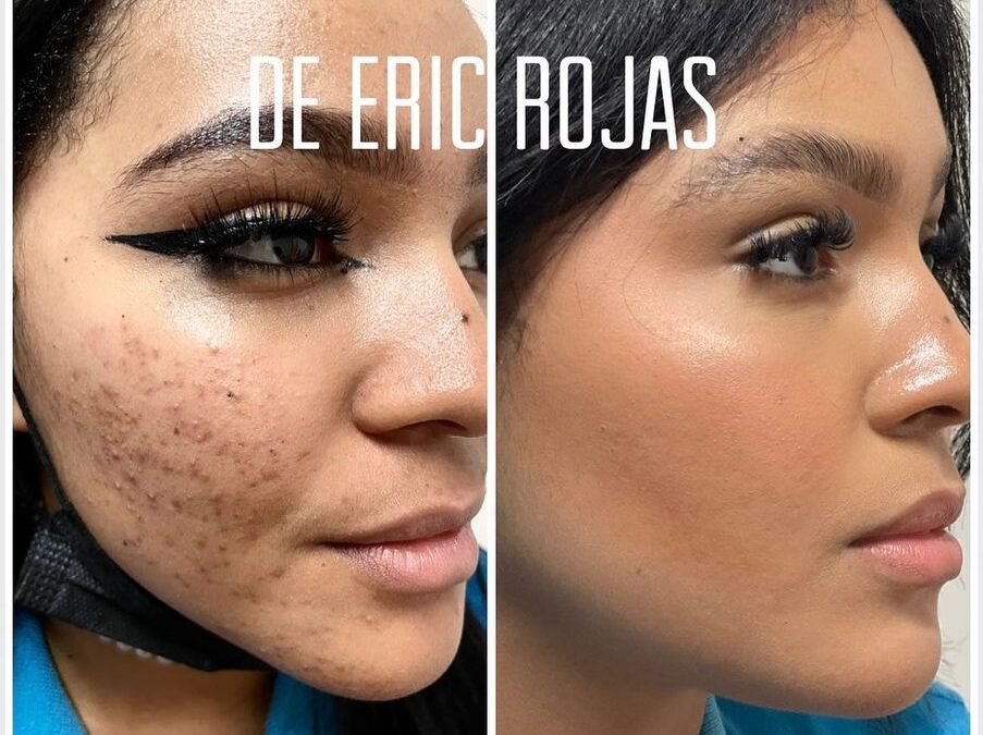 ACNE YA NO MÁS DR ERIC ROJAS 22483535