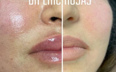 Relleno y moldeado de labios por solo $399