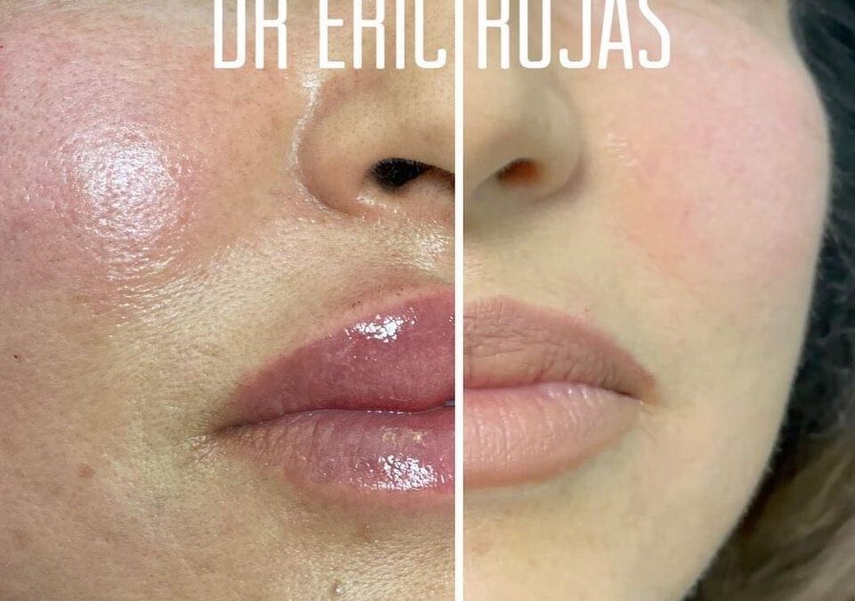Relleno y moldeado de labios por solo $399