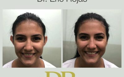 Corrección de orejas con el Dr. Eric Rojas.