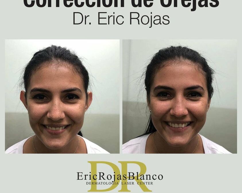 Corrección de orejas con el Dr. Eric Rojas.