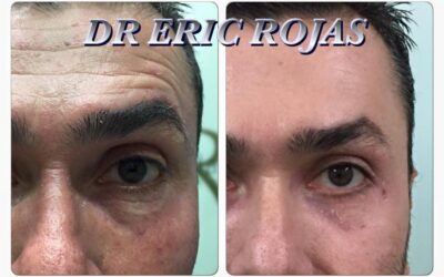 Rejuvenecimiento facial sin cirugía.