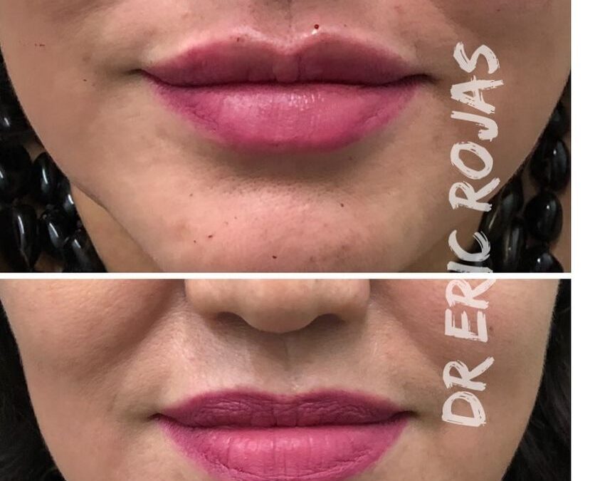 Labios definidos, la mejor oferta en $399 USD.