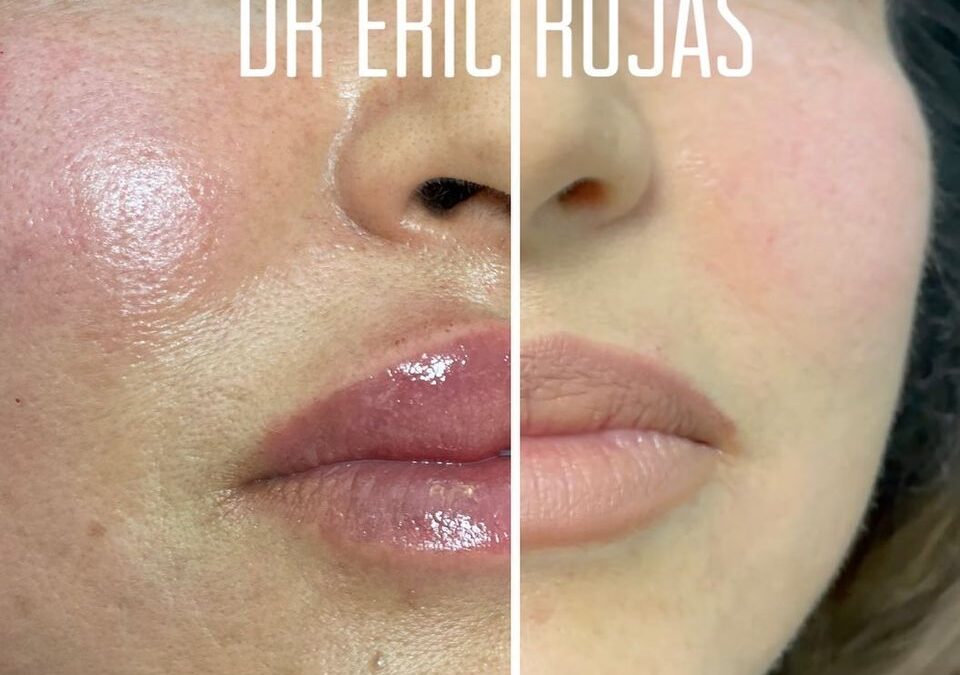 Moldeado de LABIOS Y AUMENTO DE VOLUMEN AHORA EN OFERTA 400 dólares DR ERIC ROJAS