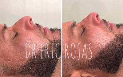 Rinolift, corrige tu nariz.  $950 dólares