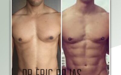Slim Láser puede marcar tu cuerpo.