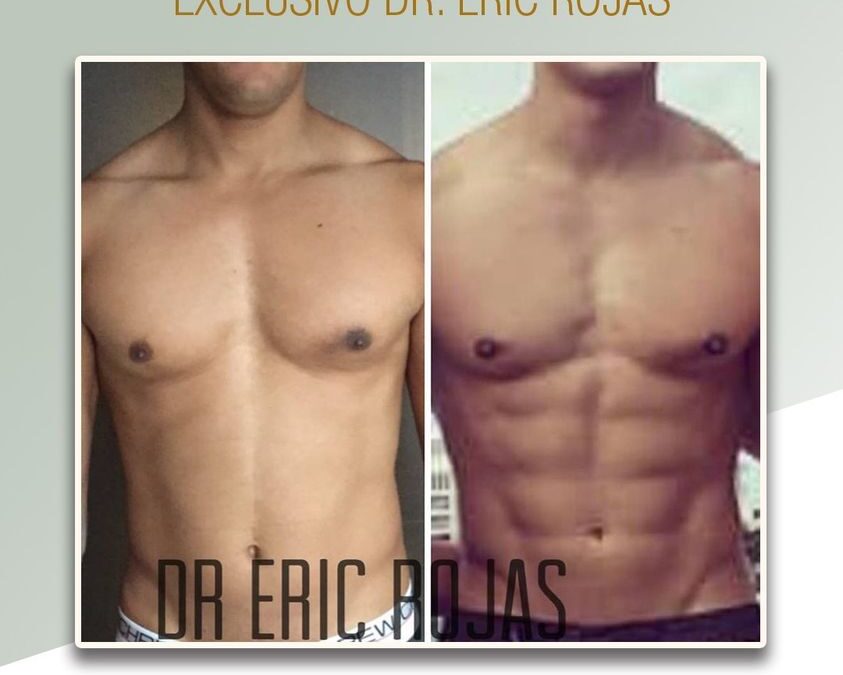 Slim Láser puede marcar tu cuerpo.