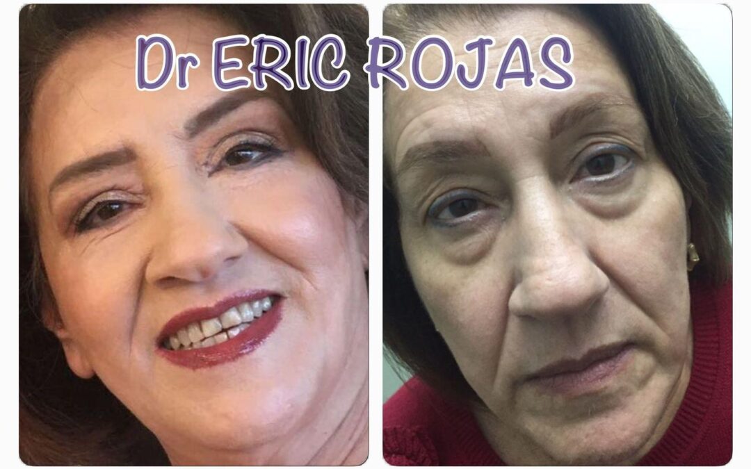 Rejuvenecimiento de Rostro.