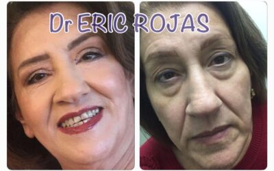 Rejuvenecimiento de Rostro.