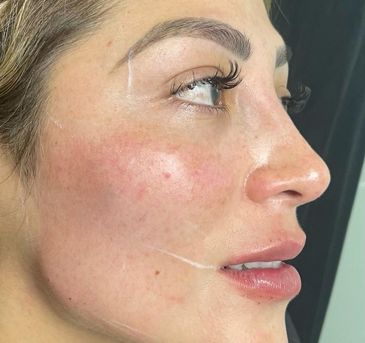 Refrescamiento facial