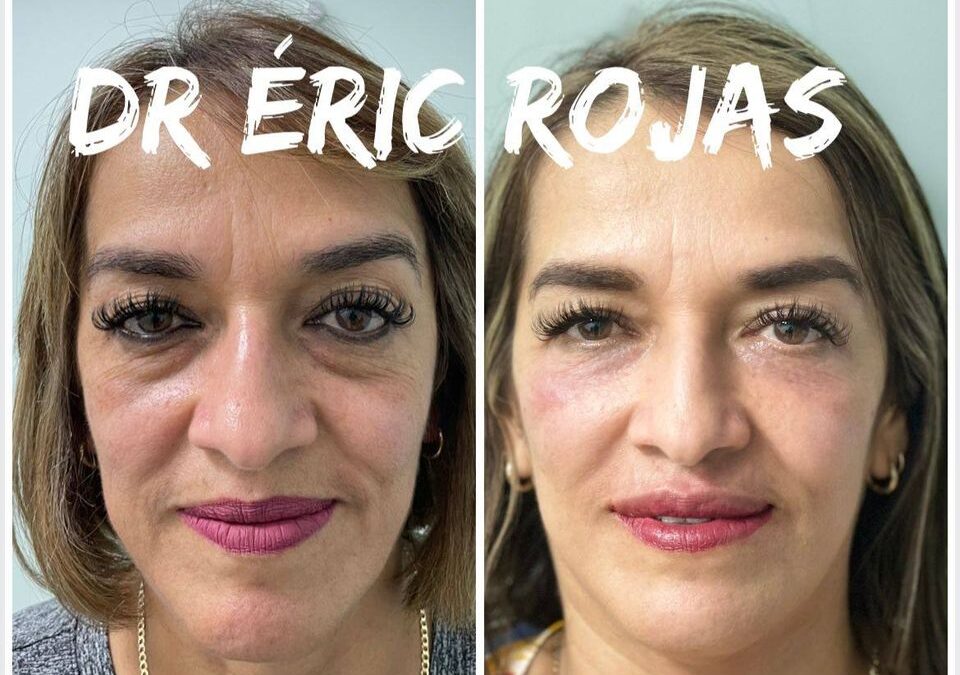 Rejuvenece tu rostro con los métodos más avanzados en refrescamiento facial.