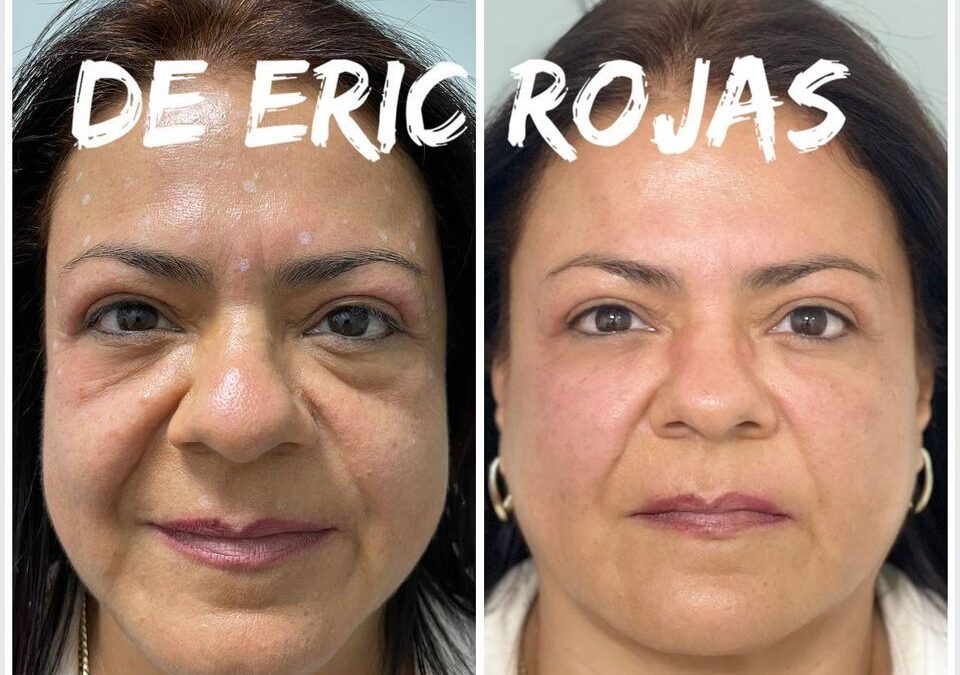 Refrescamiento facial, contamos con las mejores técnicas.
