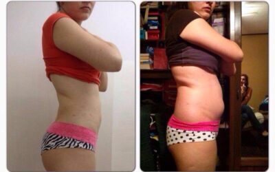 Increíble cambio Slim Láser, las diferencias son notorias.