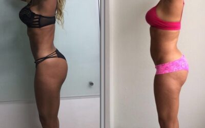 Slim Láser, la mejor opción para ti.
